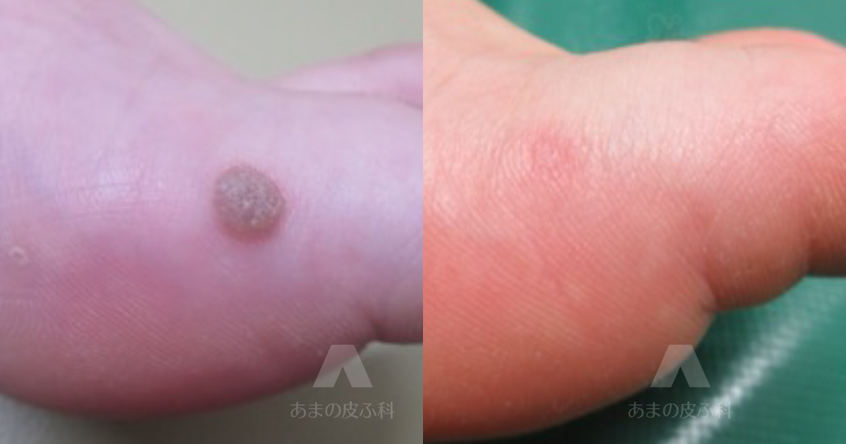 施術例尋常性疣贅（ウィルス性いぼ）（足）・10代女性