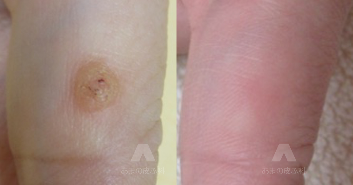 施術例尋常性疣贅（ウィルス性いぼ）（手指）・40代女性