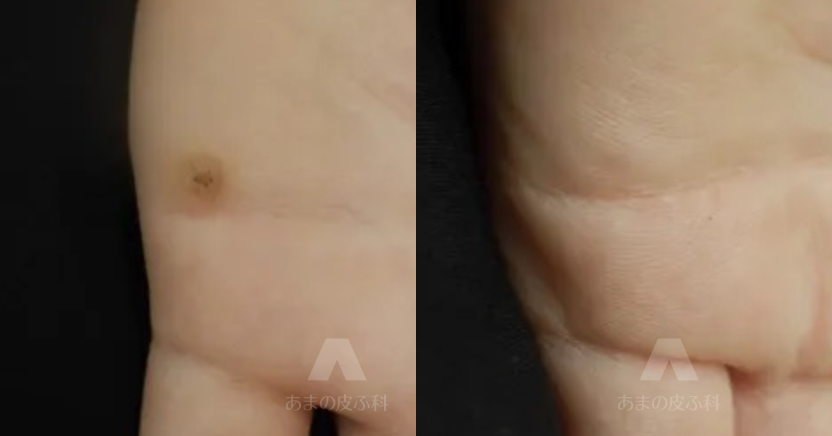 施術例尋常性疣贅（ウィルス性いぼ）（手）・6歳