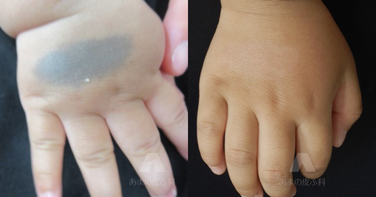 施術例異所性蒙古斑（右手背）・初診時生後6ヶ月