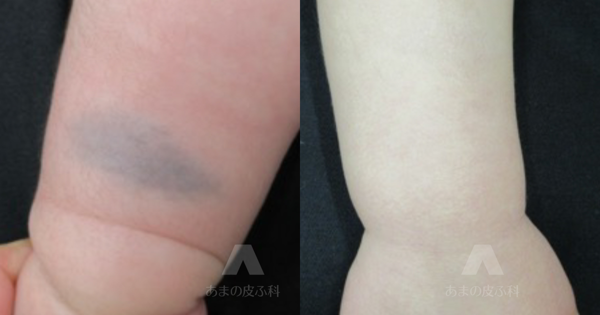 施術例異所性蒙古斑（右前腕）・初診時生後3ヶ月