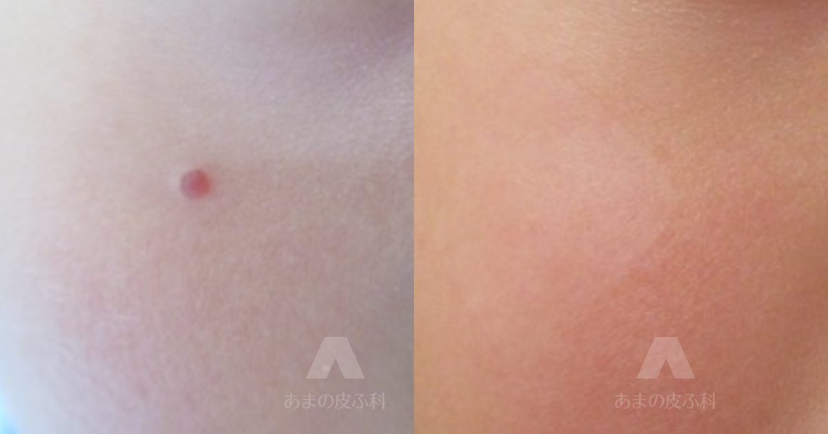 施術例血管拡張性肉芽腫（頬）・初診時2歳11ヶ月