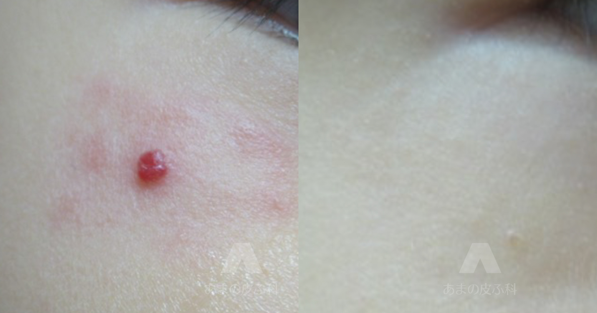 施術例血管拡張性肉芽腫（頬）・初診時1歳4ヶ月