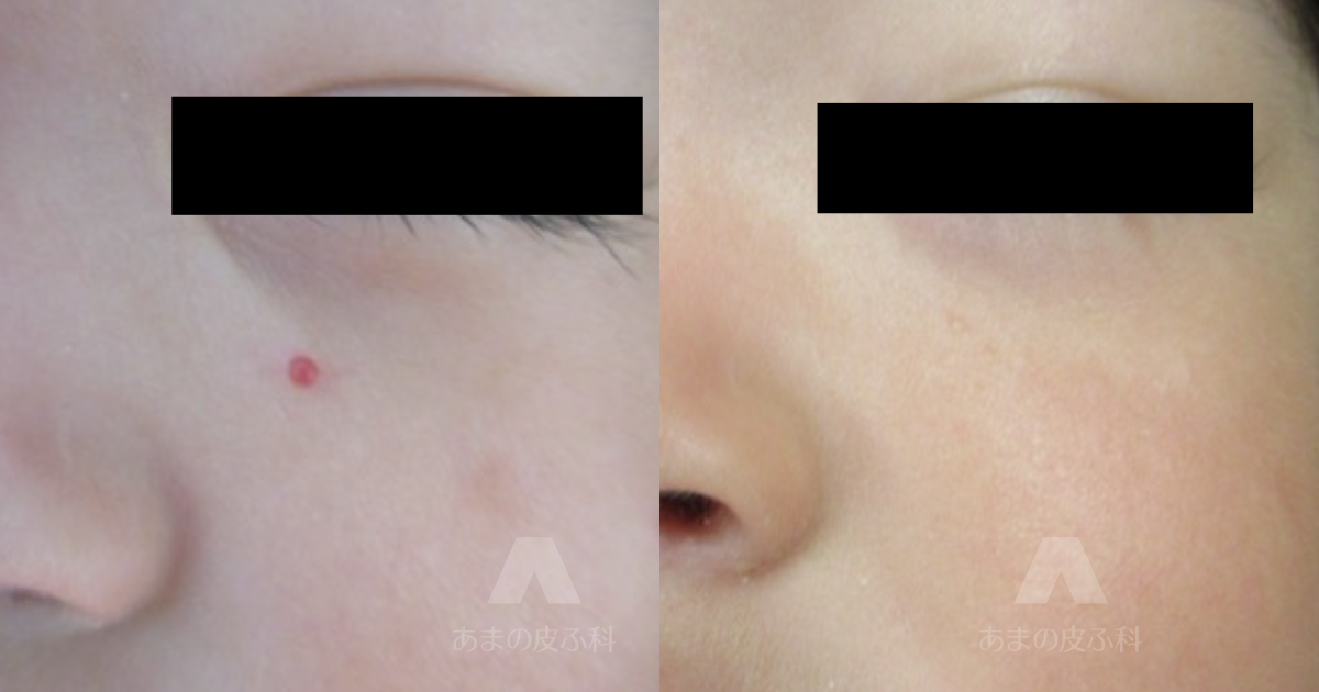 施術例血管拡張性肉芽腫（頬）・初診時2歳4ヶ月