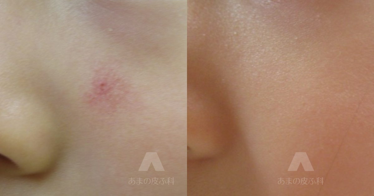 施術例星芒状血管腫（頬）・初診時4歳