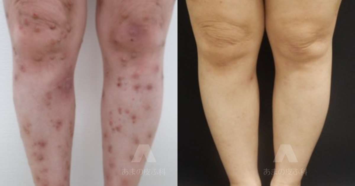 施術例結節性痒疹（四肢）・50代女性