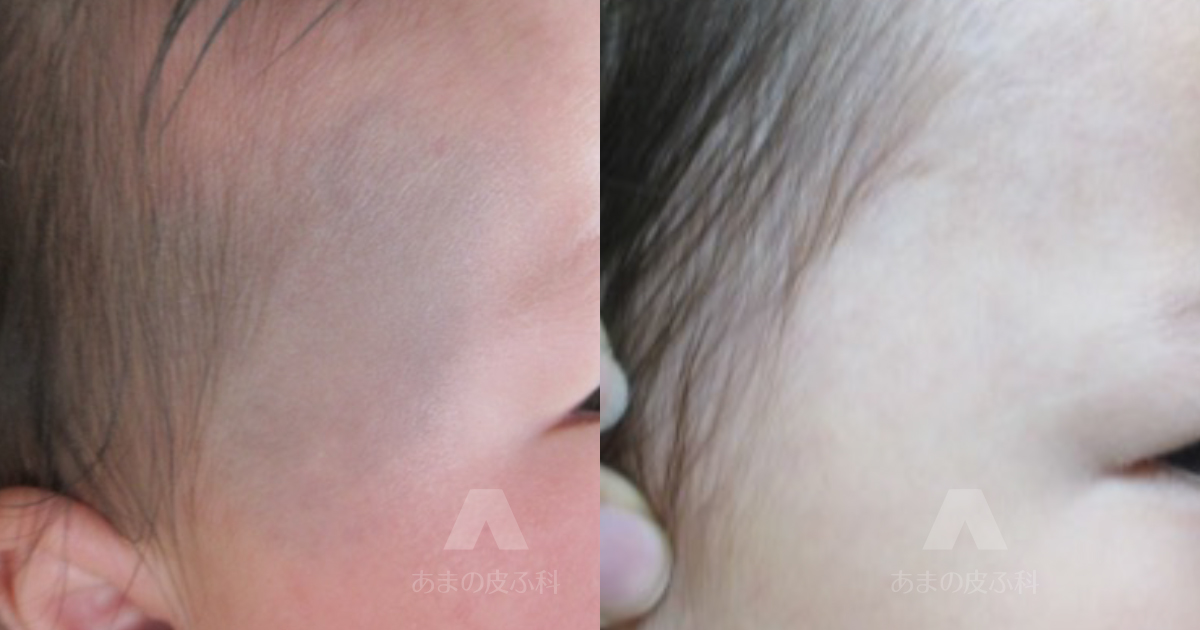 施術例太田母斑（右額～こめかみ）・初診時6ヶ月