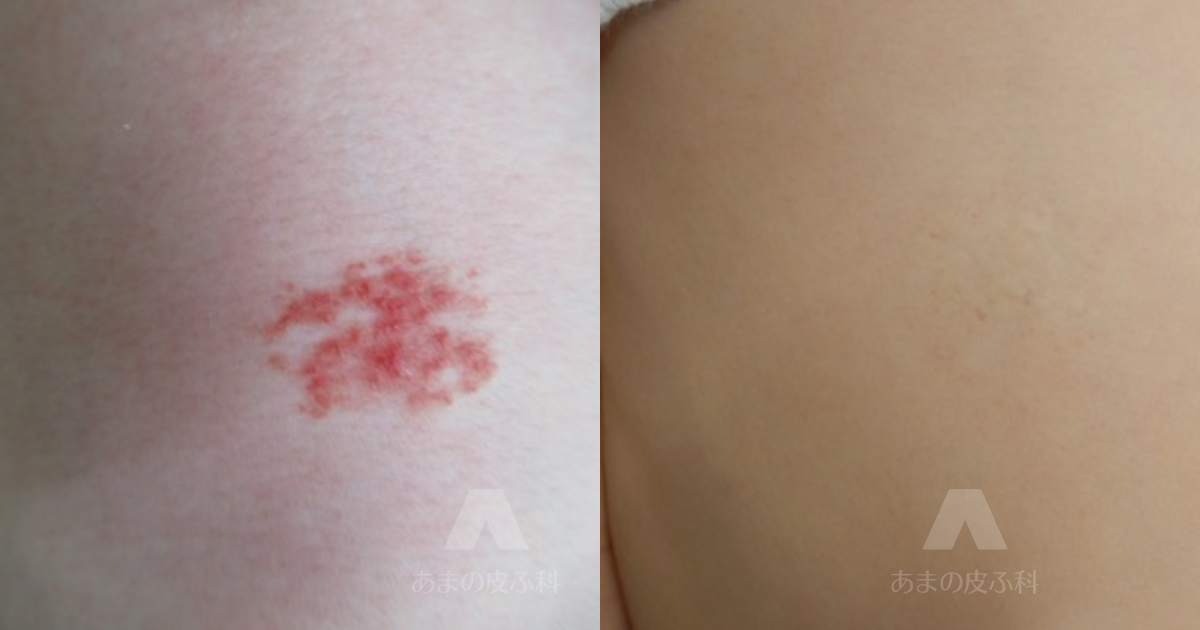 施術例乳児血管腫（右胸部）・初診時1ヶ月