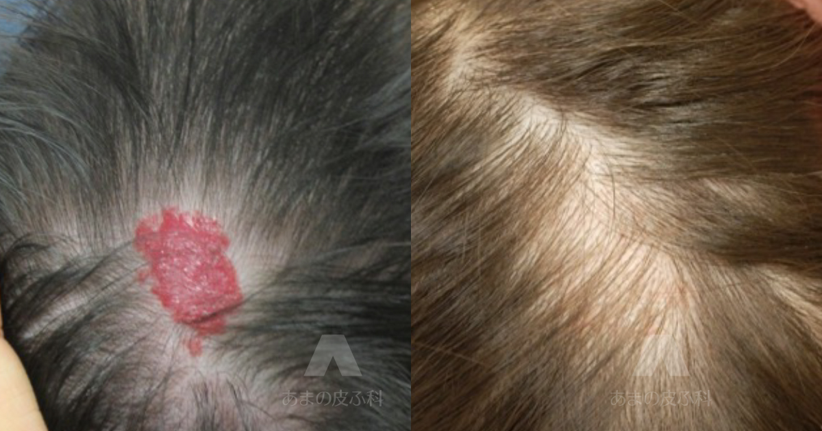 施術例乳児血管腫（頭部）・初診時1ヶ月