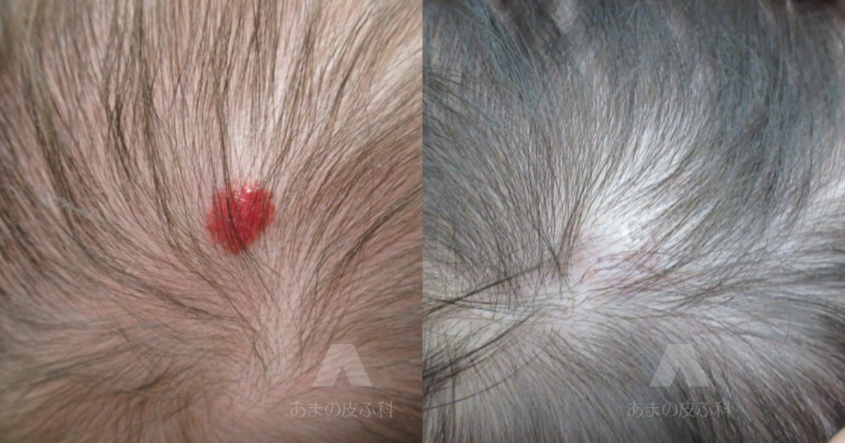 施術例乳児血管腫（頭部）・初診時1ヶ月