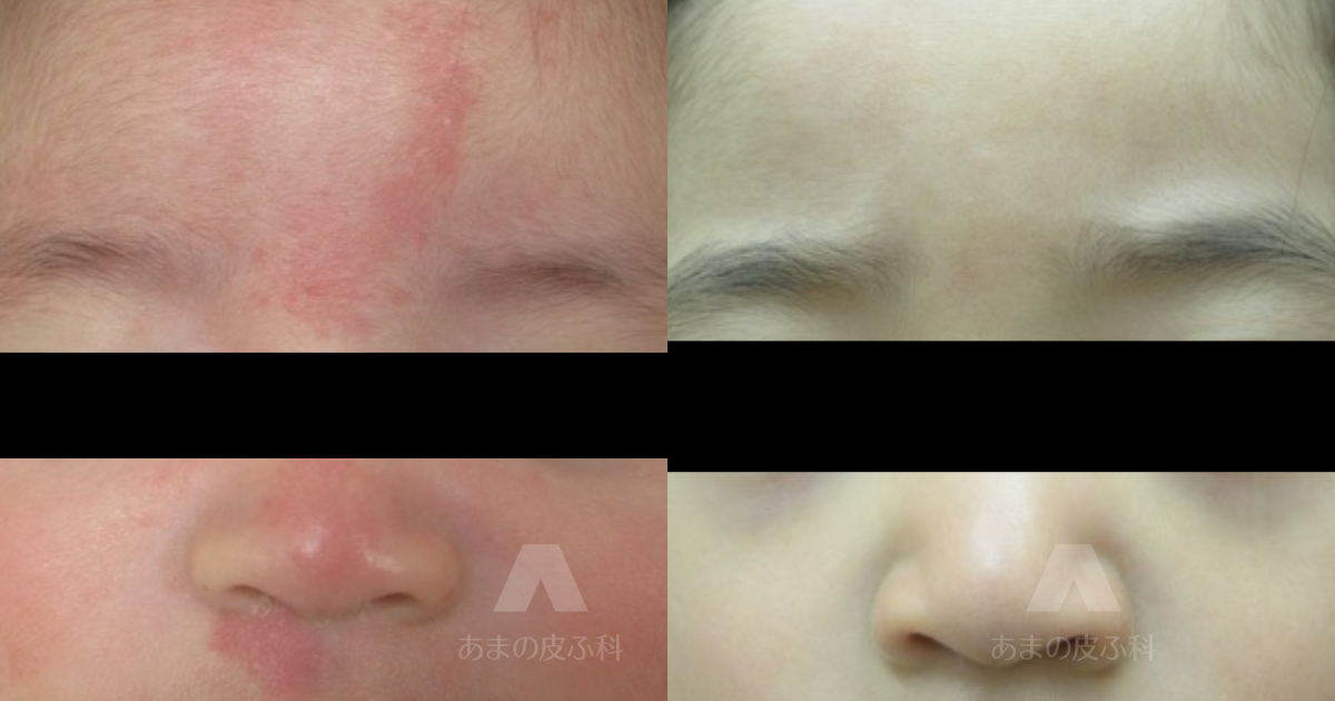施術例正中部母斑（サーモンパッチ）（額・眉間・鼻・上口唇）・初診時3ヶ月