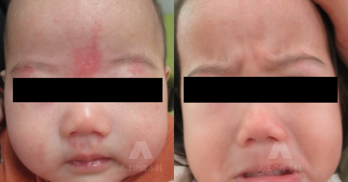 施術例正中部母斑（サーモンパッチ）（額・眉間・上眼瞼・上口唇）・初診時3ヶ月