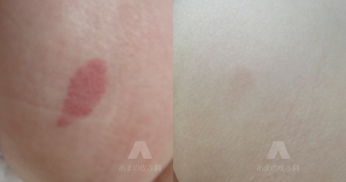 施術例毛細血管奇形（臀部）・初診時5ヶ月