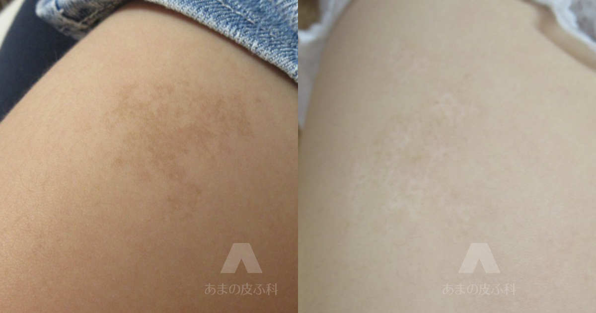 施術例扁平母斑（右大腿部）・初診時2歳