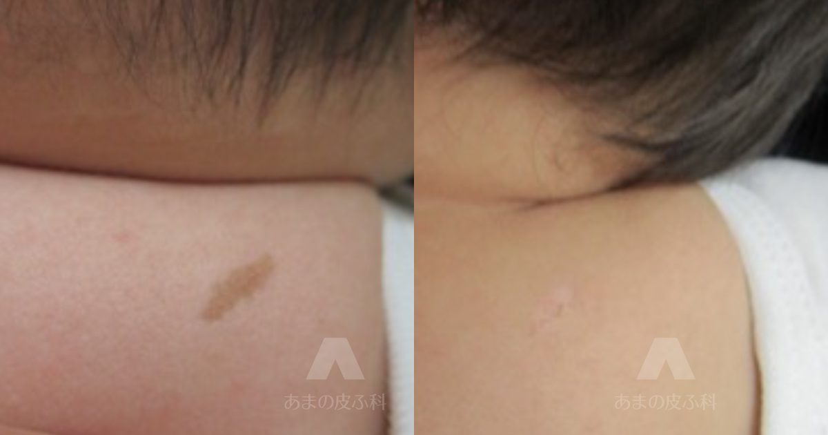 施術例扁平母斑（後頚部）・初診時8ヶ月