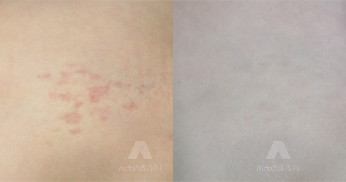 施術例毛細血管奇形（腰部）・初診時2歳3ヶ月