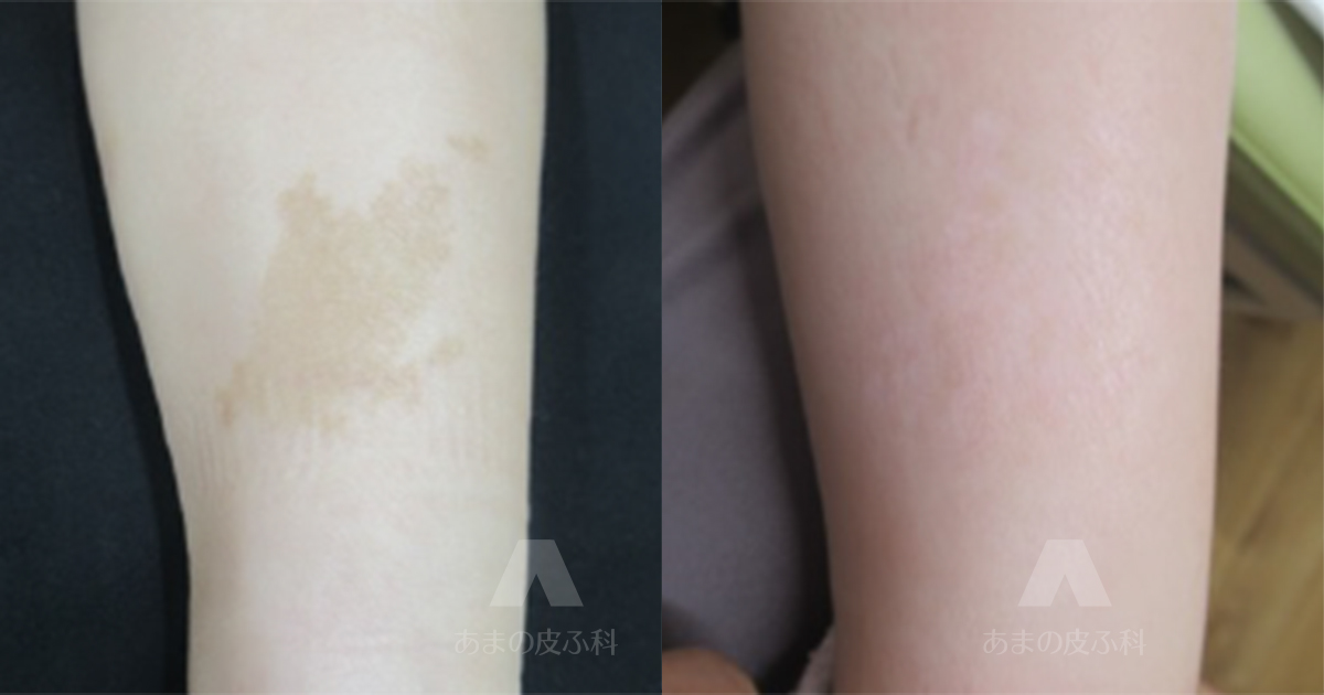 施術例扁平母斑（左下腿）・初診時3歳2ヶ月