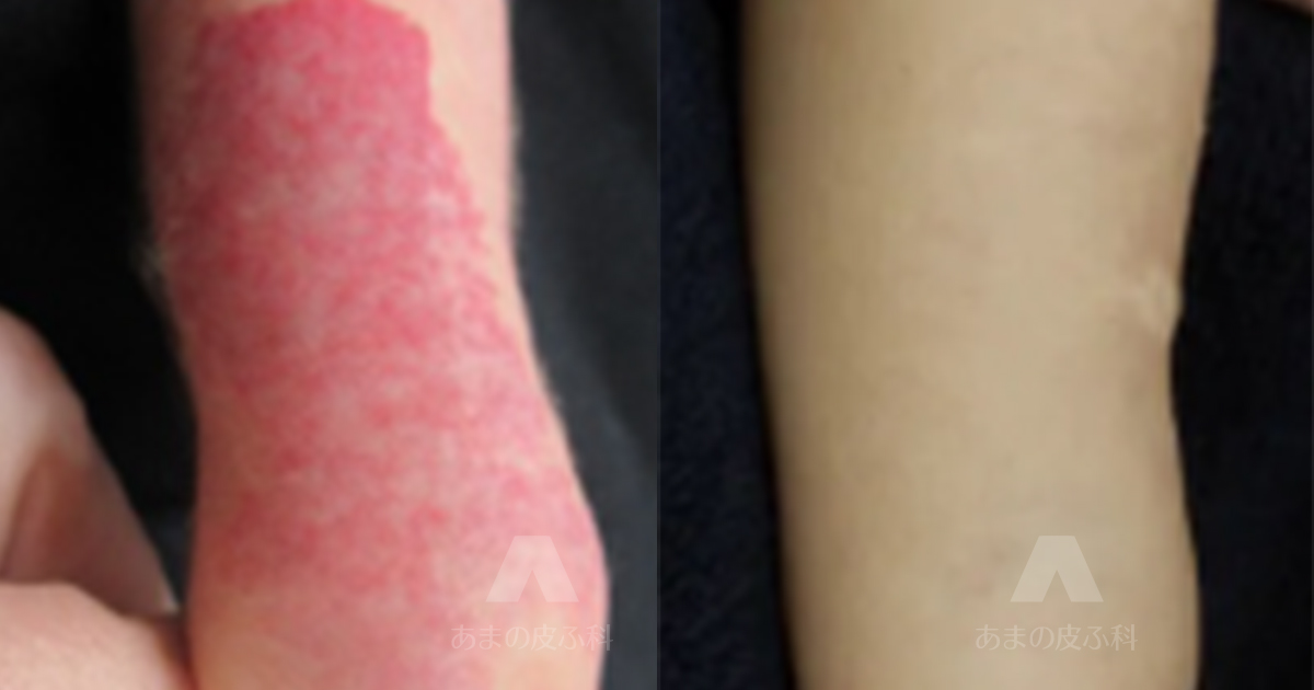 施術例乳児血管腫（右前腕）・初診時1ヶ月