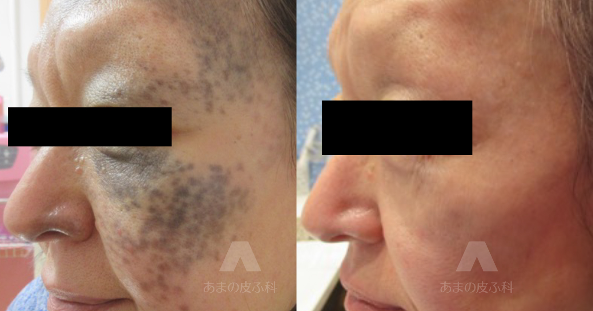施術例太田母斑（左上下眼瞼、額、頬）・50代女性