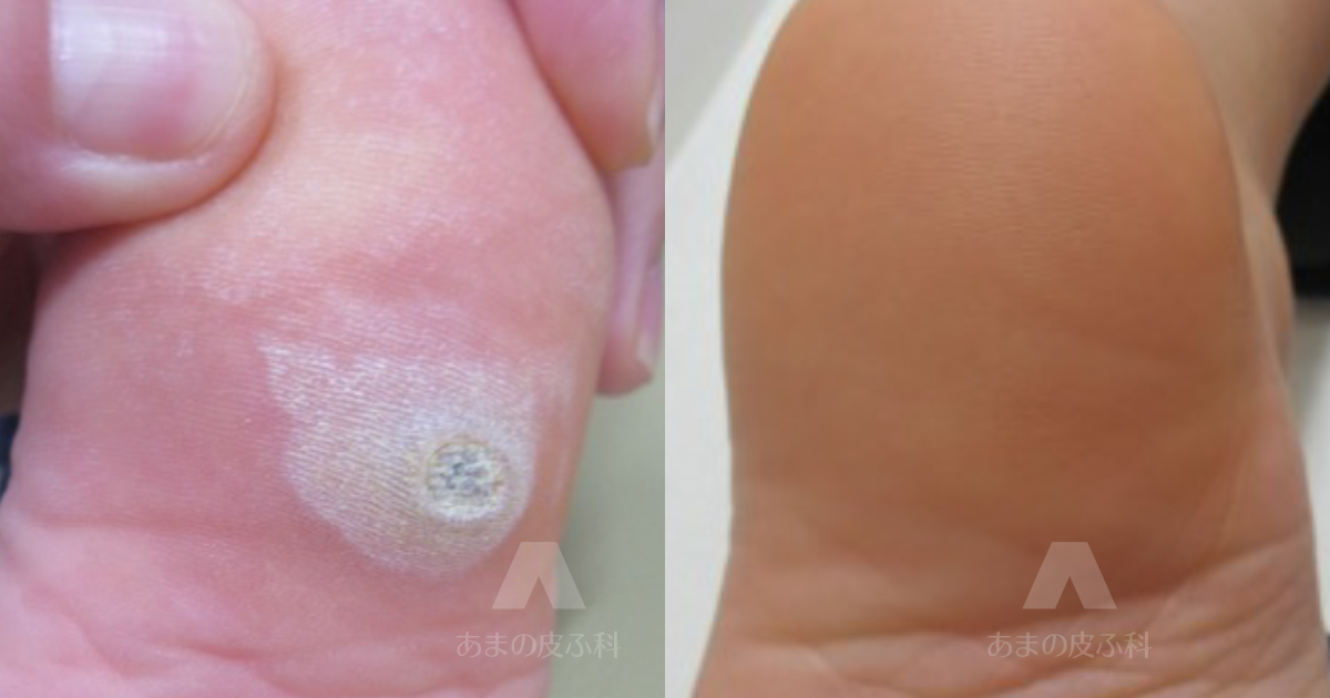 施術例尋常性疣贅（ウィルス性いぼ）（かかと）・6歳女性