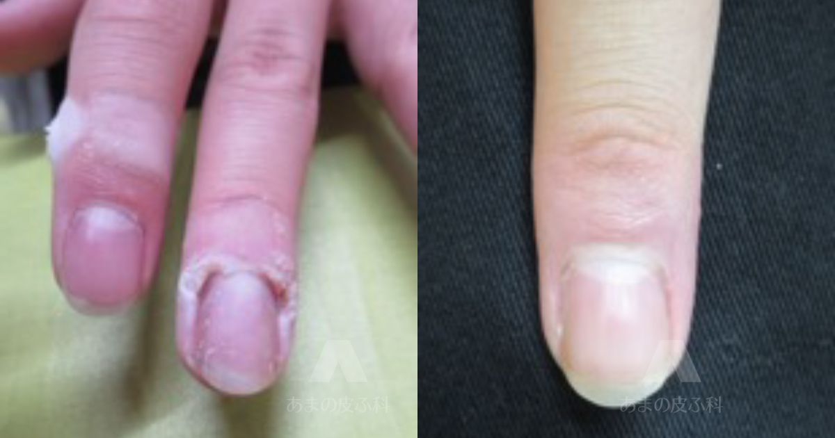 施術例尋常性疣贅（ウィルス性いぼ）（手指）・10代男性