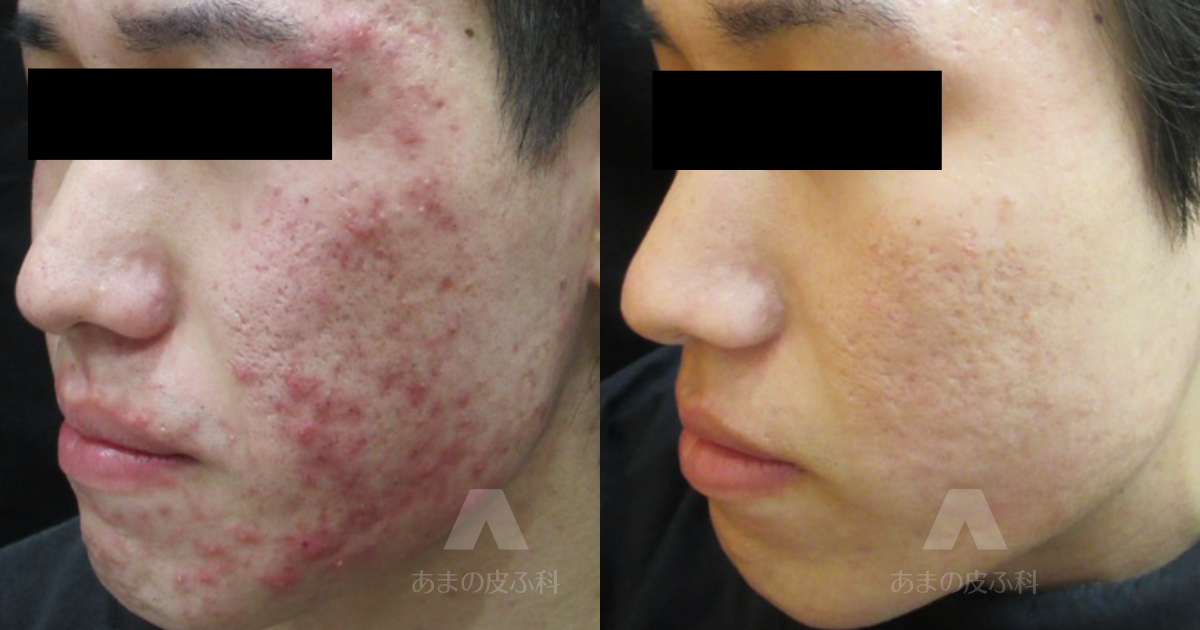 施術例にきび、にきび跡・20代男性